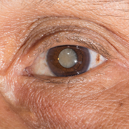 cataractă sau doar miopie